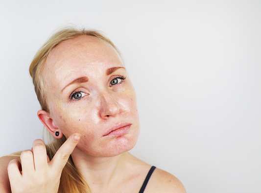 How to Get Rid of Oily Skin?